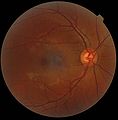 A fundus photograph showing the macula as a spot to the left. The optic disc is the area on the right where blood vessels converge. The grey, more diffuse spot in the centre is a shadow artifact.