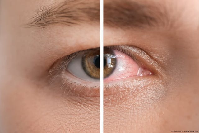 Before and after closeup of dry eye treatment Image credit: ©Pixel-Shot - adobe.stock.com