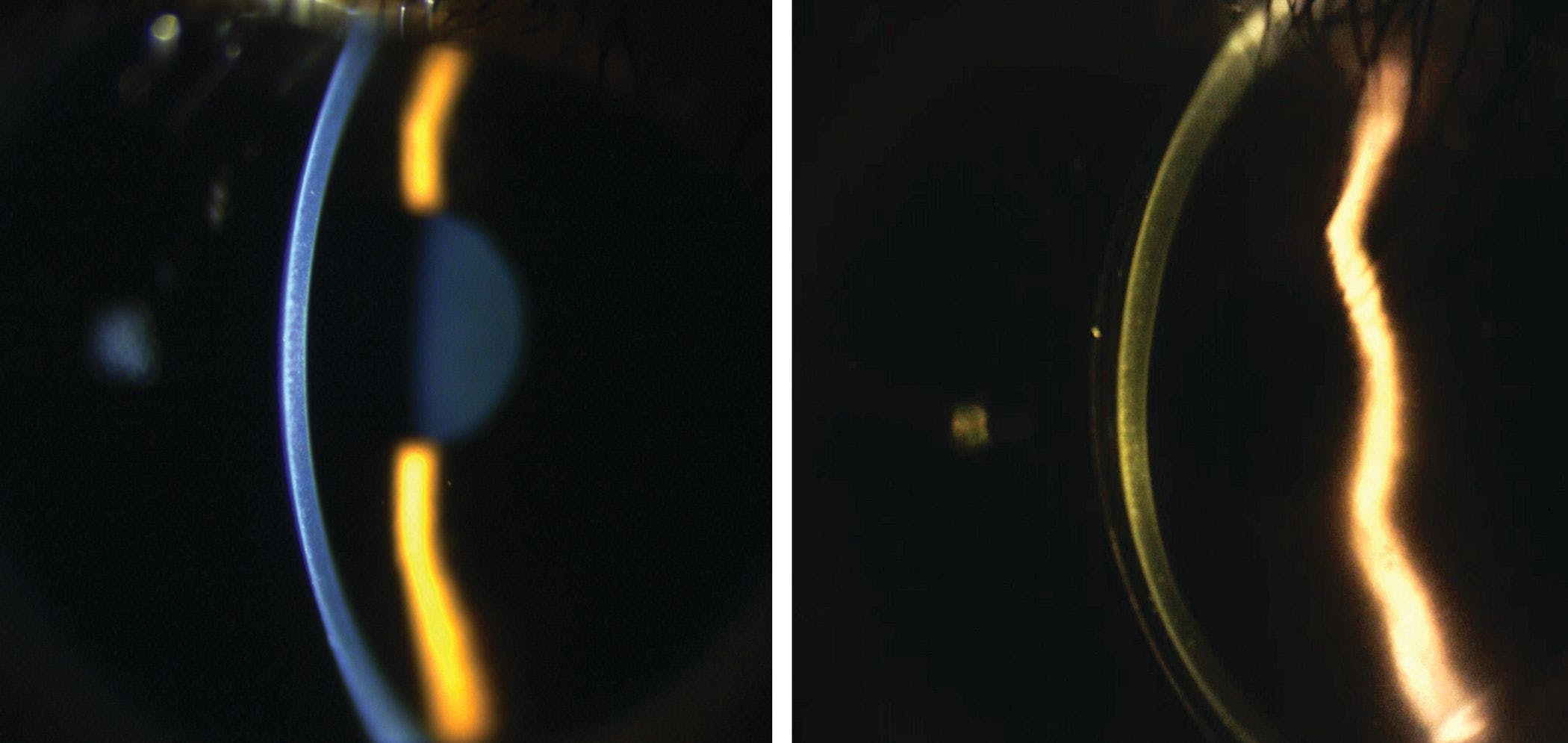 Basic and beyond: technology for every level of scleral lens management