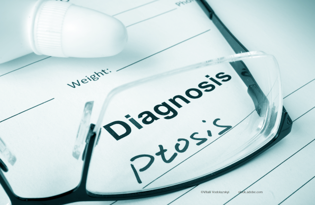 Eyelid ptosis case treated with brimonidine 0.33% gel