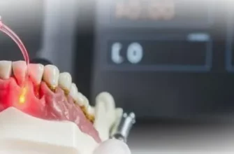 Что такое лазерная имплантация зубов?