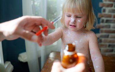 Toddler being treated for chickenpox viral rash