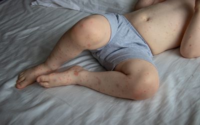 A young boy with a roseola rash